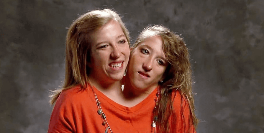 future of conjoined twin care