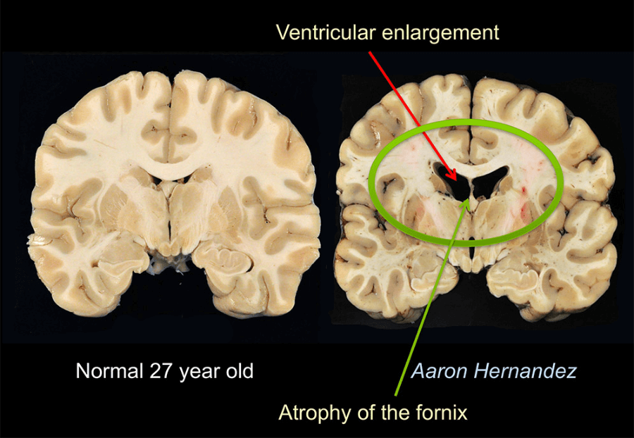 link between cte and criminal behavior