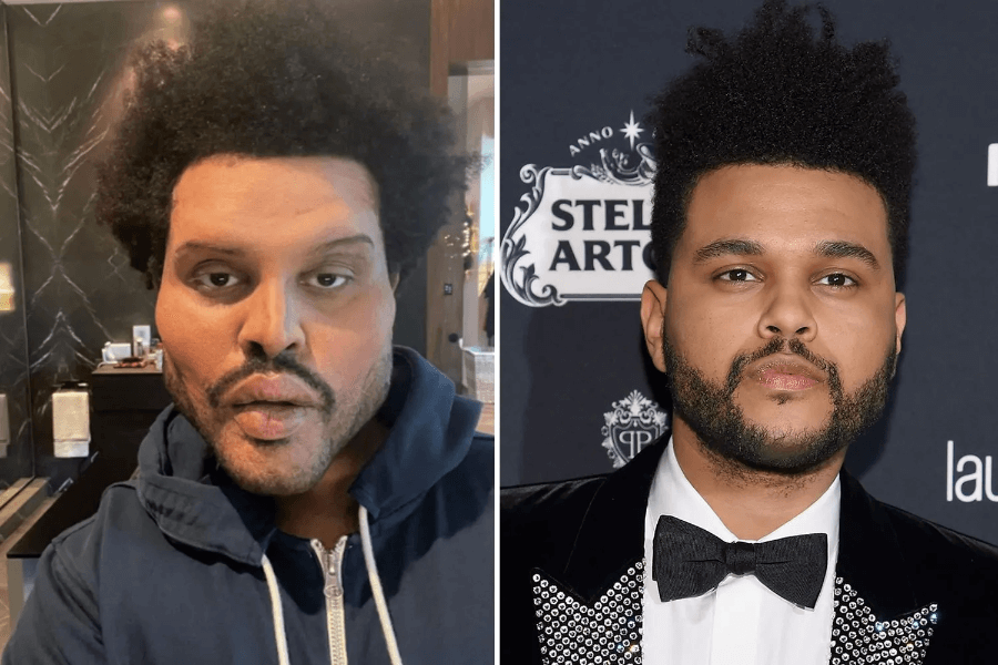 the weeknd plastic surgery