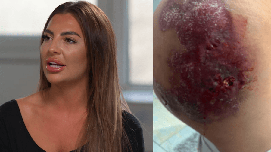 botched brazilian butt lift